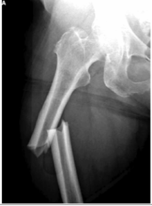 Femoral Fracture
