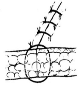 simple inter sutures
