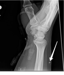 X-ray wound