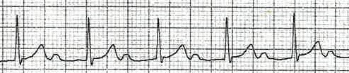 1st Degree Heart Block
