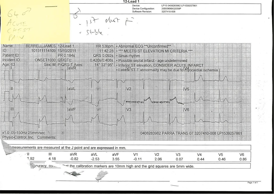 Faxed ECG from and Ambulance - Their patient has Severe Chest Pain and a history of smoking