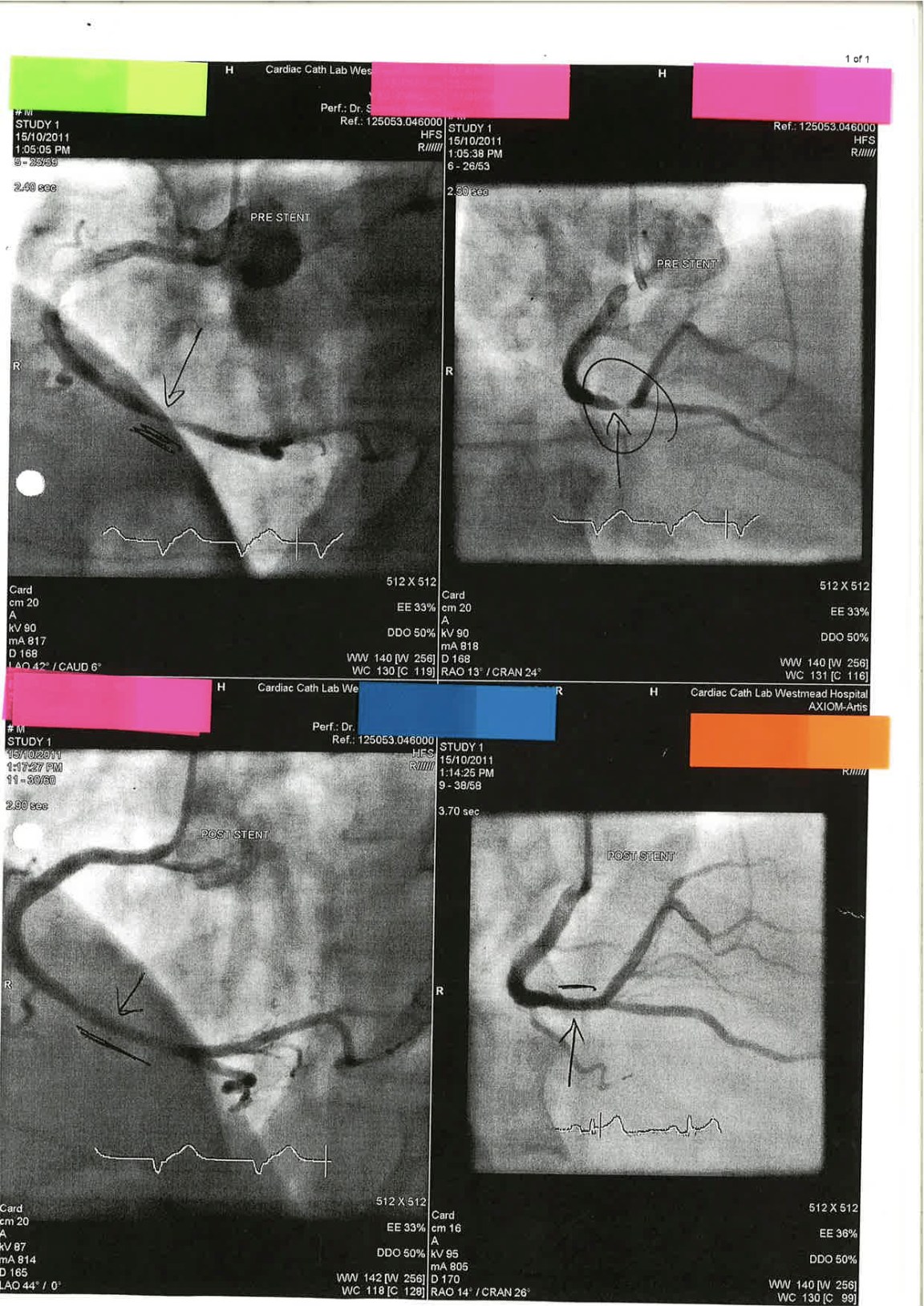 Angiogram Findings for Patient from ECG 8