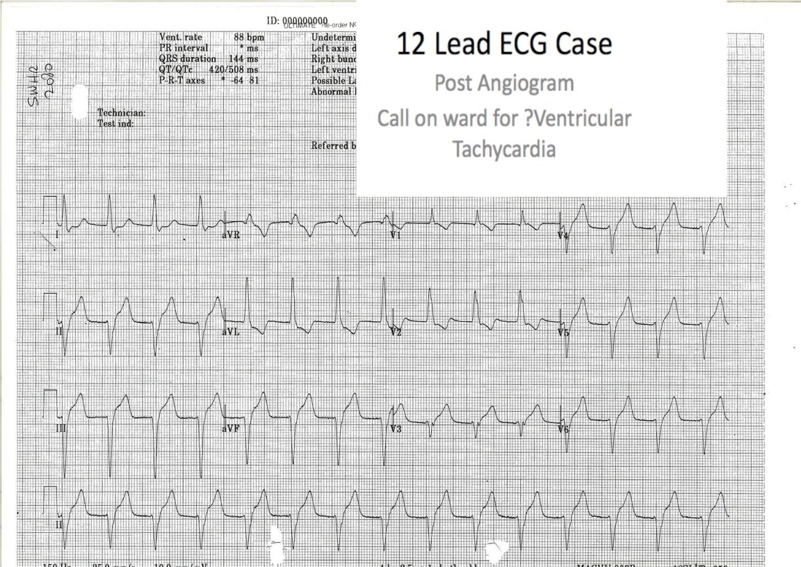 Acute MI and Reperfusion