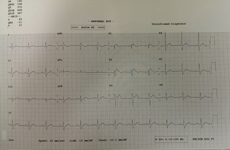 Brugada Syndrome