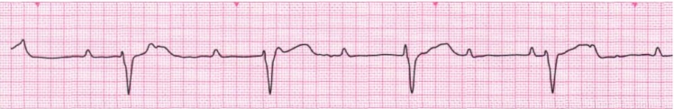 Complete Heart Block