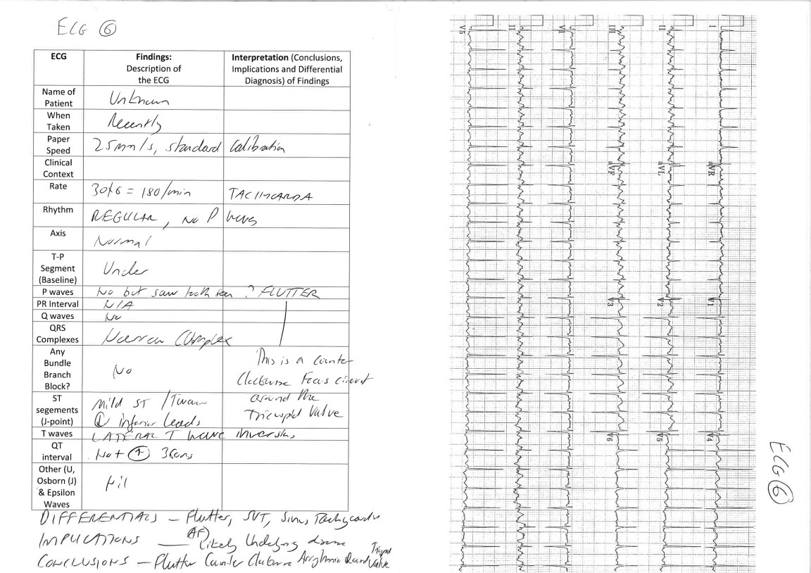 ECG Narrow Complex Tachycardia