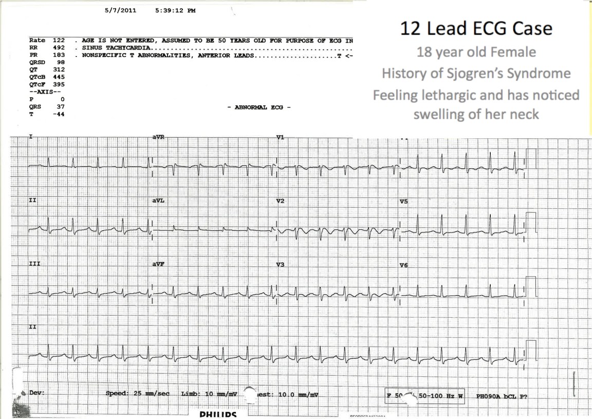 ECG showing Sinus Tachycardia, QT prolongation and T wave inversions - The serum K was 2.3