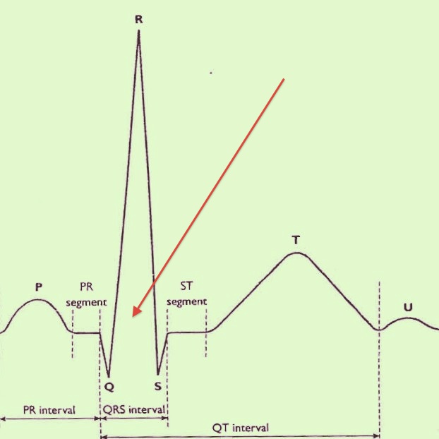 QRS complex - marked with Red Arrow