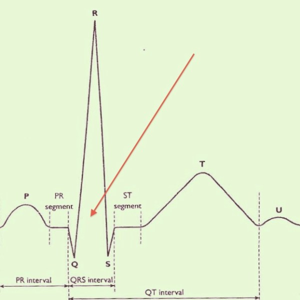 12 Lead ECG – EmergencyPedia