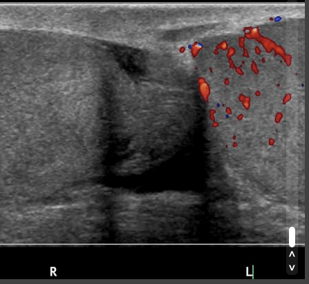 Testicular Torsion Flow