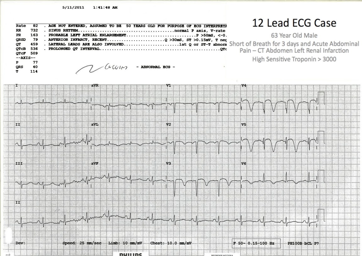 Striking T Wave Inversion suggestive of Wellen's Syndrome