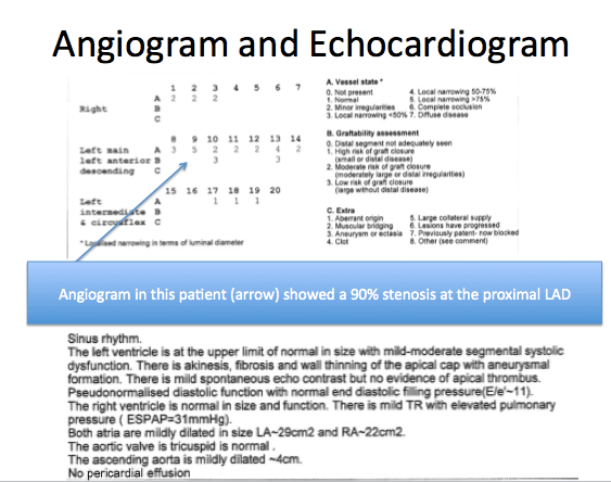 Angiogram and Echo findings for ECG 16