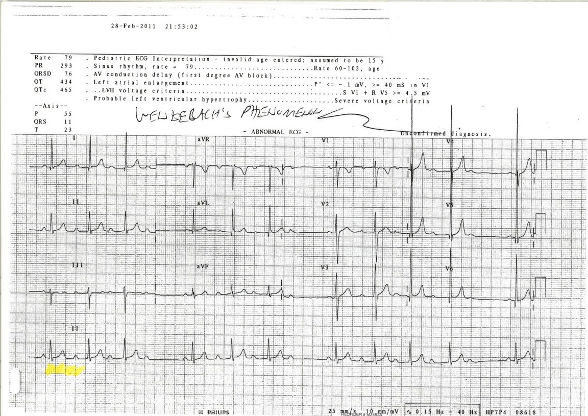 Mobitz Type I (Wenckebach Phenomenon)