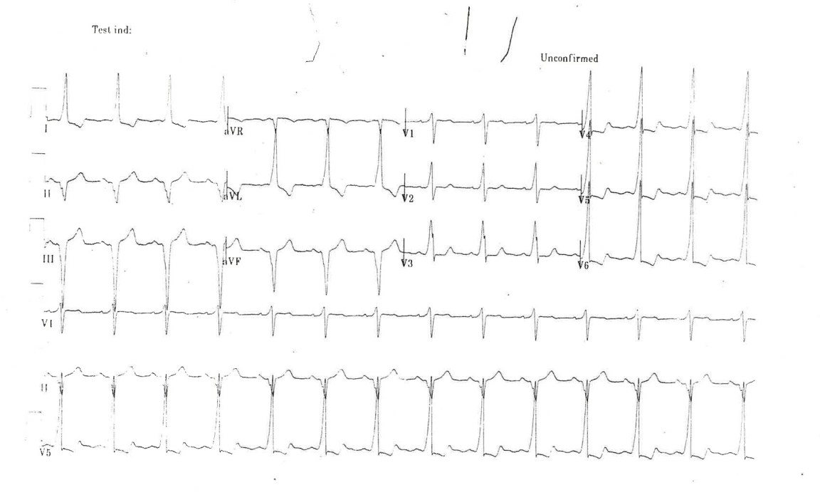 Underlying WPW seen on Repeat 12 Lead ECG