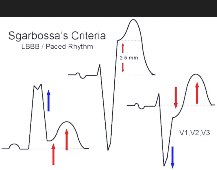 The Original Sgarbossa Criteria