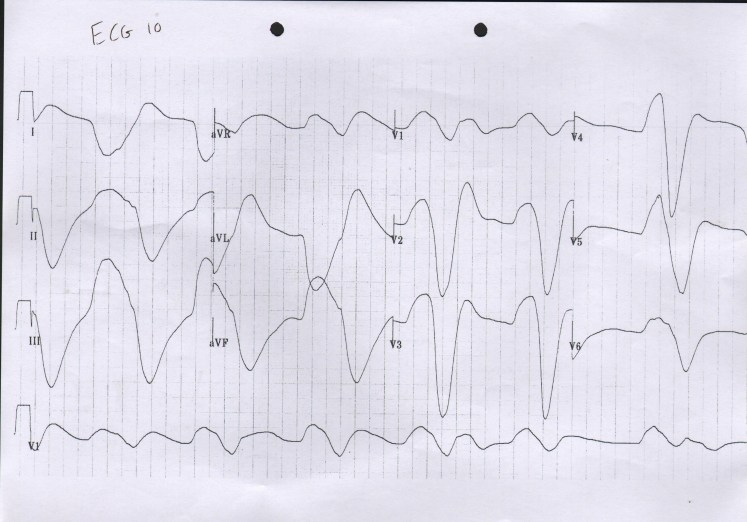 High K - Hyperkalaemia