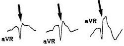 Progressive Dominant R waves in AVR