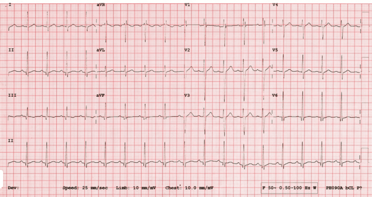 20 year old with Chest Pain