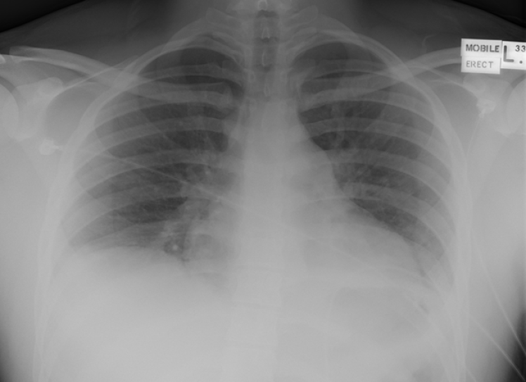 Repeat CXR