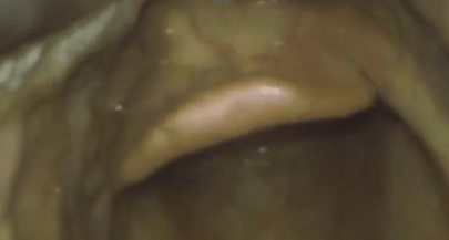 Visulise the Epiglottis