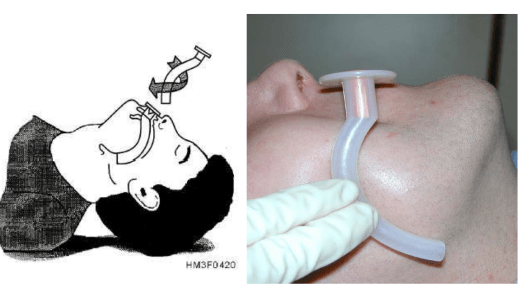 OP Airway